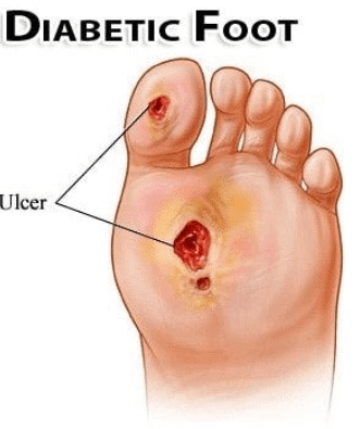Diabetic Foot Clinic in Ludhiana